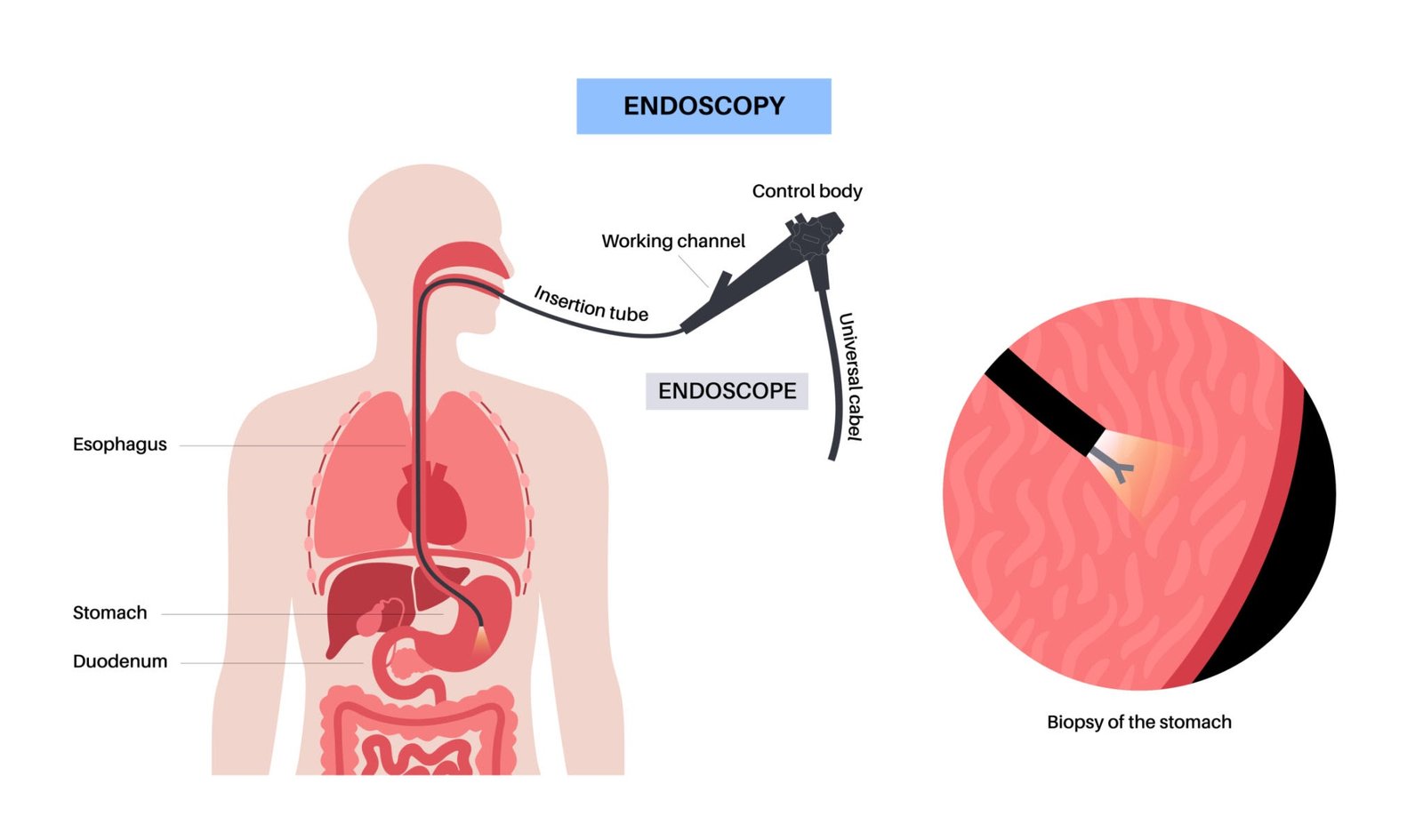 Difference Between Endoscopy and OGD Scopy
